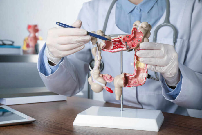 Doctor pointing at anatomical model of the colon.