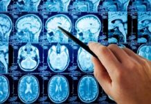 Long-Term Illness Shows Brain Changes Hand pointing at brain MRI scans with a pen